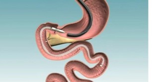 Endobarrier