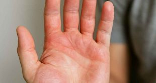 Hand showing redness and dryness