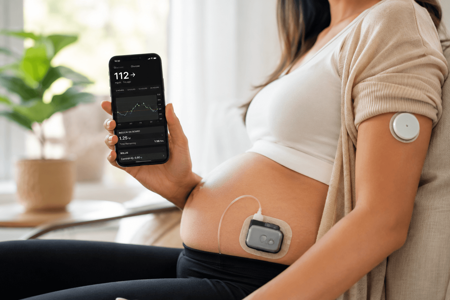 Pregnant woman using an automated insulin delivery system and continuous glucose monitor to manage type 1 diabetes during pregnancy