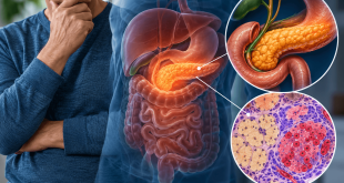 Medical illustration showing the exocrine pancreas and digestive system in an adult with type 2 diabetes.